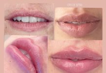 Preenchimento labial