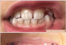 Pigmentação Extrínseca